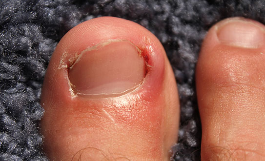 slide-ingrown-toenail